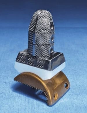 3D-printed Tantalum ankle joint